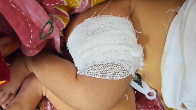 কলাপাড়ায় বেসরকারি হাসপাতালে নার্সের অবহেলায় পা ভাঙলো নবজাতকের