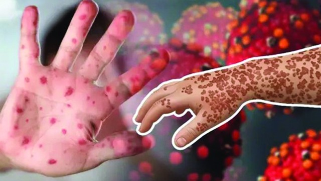 হাম ও উপসর্গে ২৪ ঘণ্টায় আরো ৭ জনের প্রাণহানি