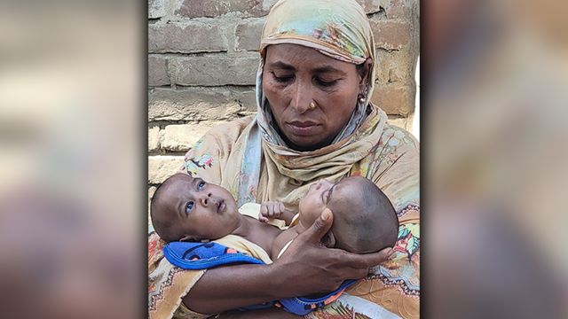 দৌলতপুরে জন্ম নিলো এক দেহে দুই প্রাণের ফুটফুটে জমজ কন্যা সন্তান
